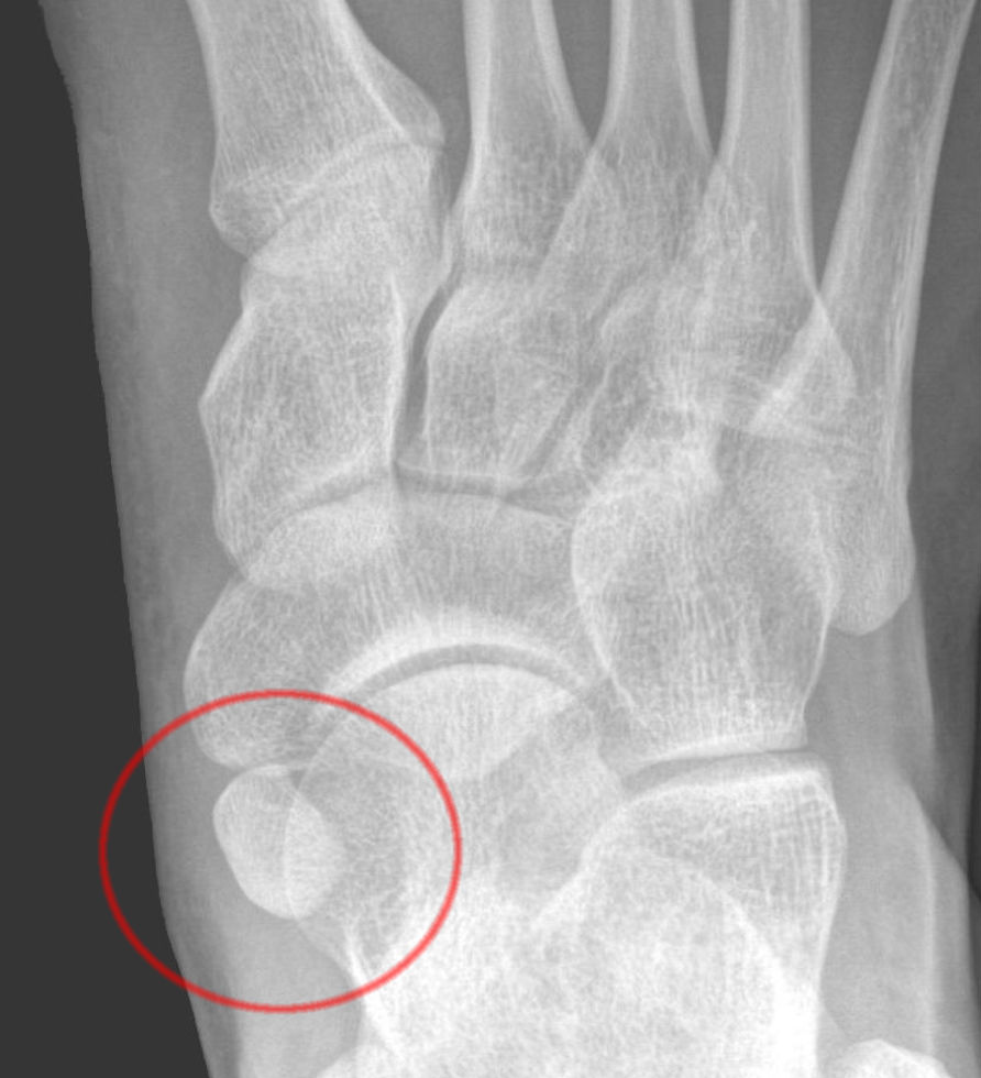 Os tibiale externum rasitusosteopatia Ultraraastaja